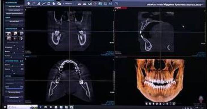 3D снимок зубов